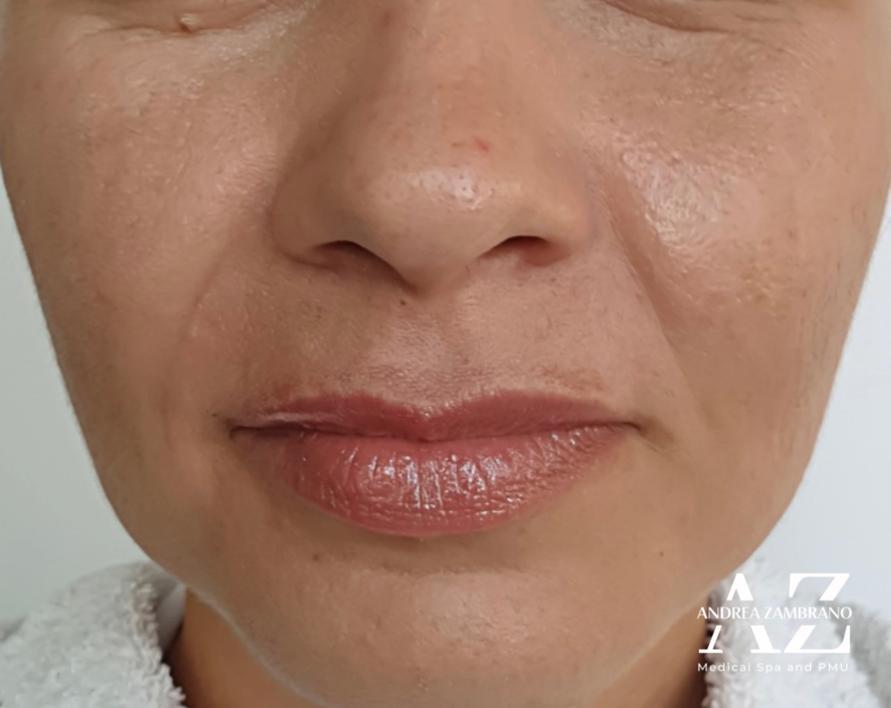 Antes Plasma Antes Plasma